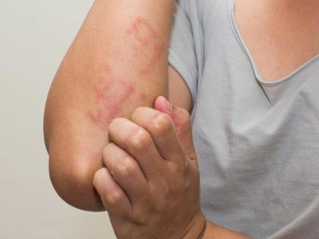 Nghiên cứu về các phản ứng có hại nghiêm trọng trên da do thuốc: Xác định nguyên nhân và cách phòng ngừa, đã được đăng trên tạp chí Annals of Allergy, Asthma and Immunology  2019 Nov;123(5):483-487