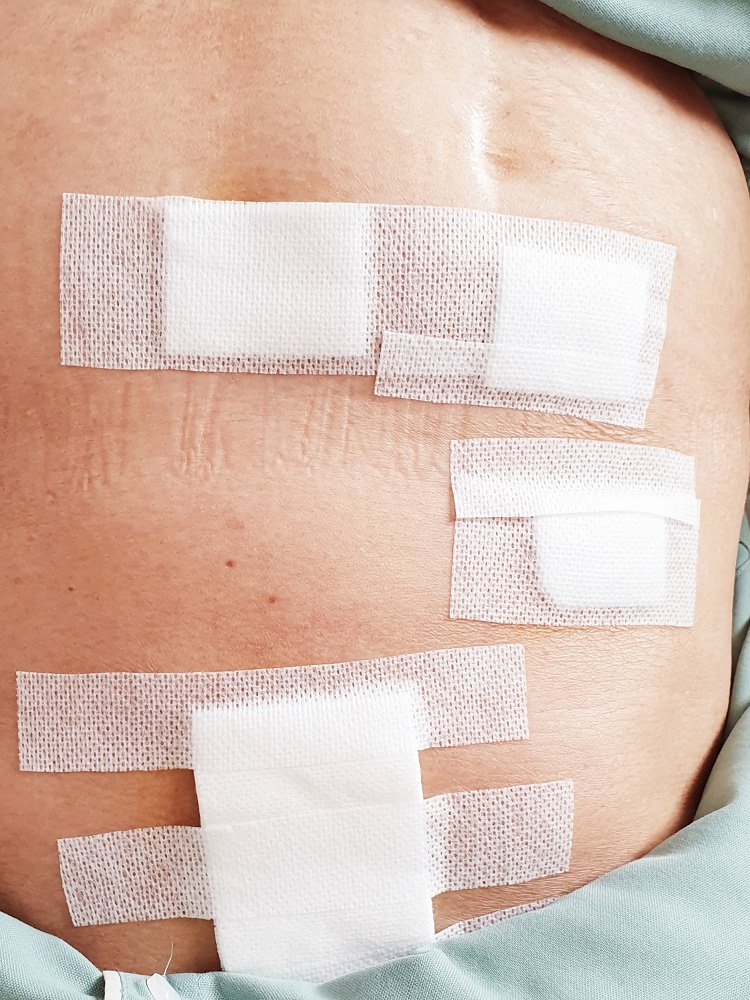 Ra viện sau mổ ung thư dạ dày