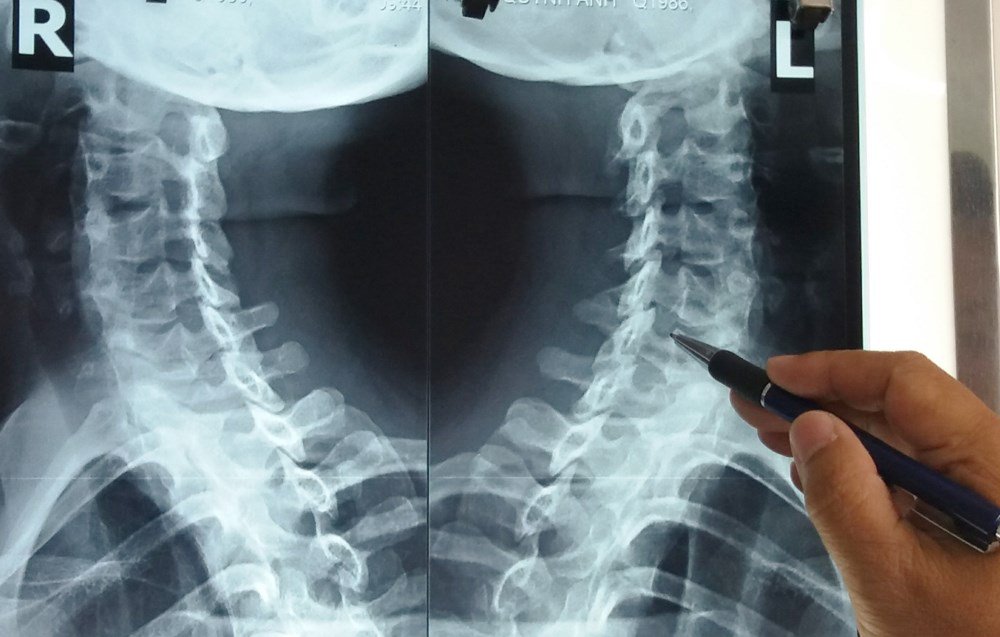 chụp cắt lớp vi tính cột sống cổ