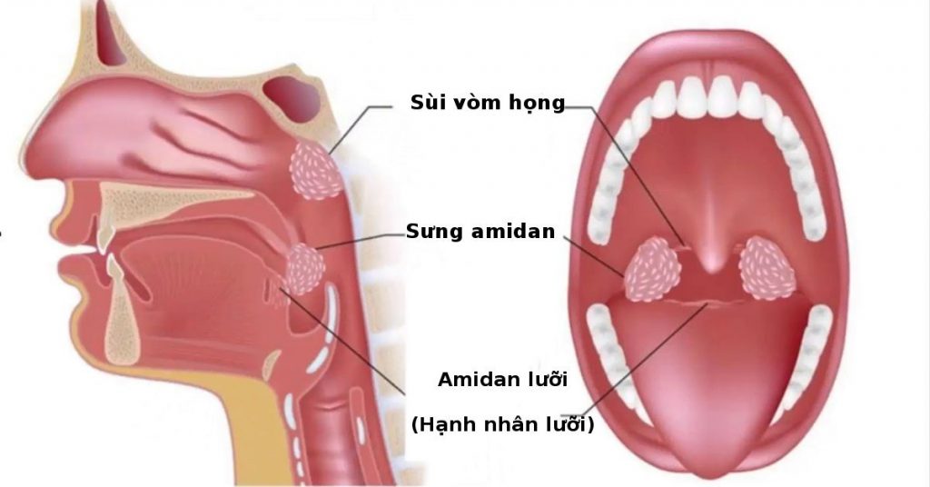 chích rạch abces quanh amidan