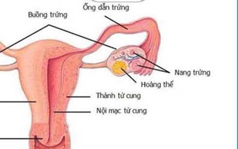 chọc nang tồn dư