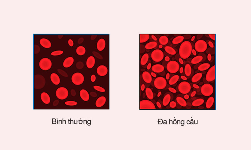 đa hồng cầu sơ sinh