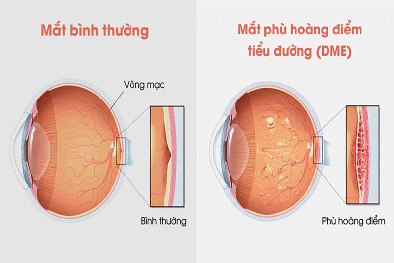 Hướng dẫn chẩn đoán và điều trị phù hoàng điểm do đái tháo đường (Diabetic Macular Edema – DME)