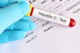 Hướng dẫn quy trình chuyên môn xét nghiệm HCV Ab test nhanh